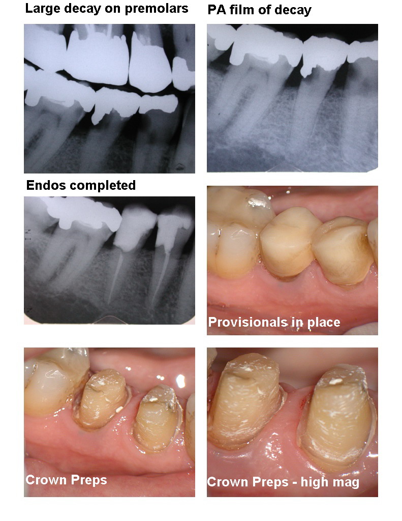 Premolar osseous pg 1.jpg